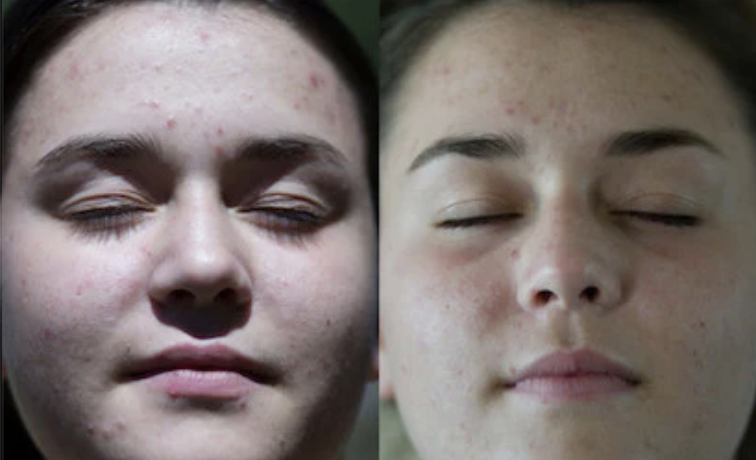 Before and After Using Western Natural Skincare